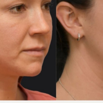 Смас ліфтинг обличчя + шия + декольте
                    Косметологический центр Safe Cosmo Kyiv Киев