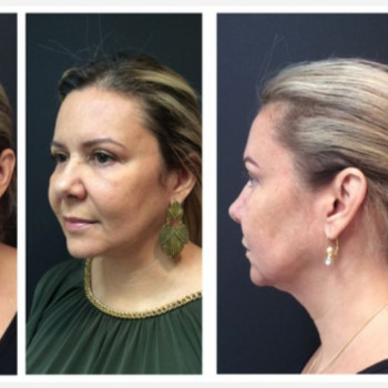 Смас ліфтинг обличчя + шия + декольте
                    Косметологический центр Safe Cosmo Kyiv Киев