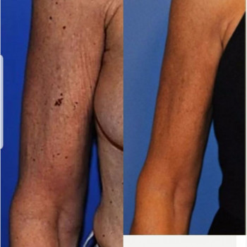 Смас ліфтинг руки + шия + декольте
                    Косметологический центр Safe Cosmo Kyiv Киев