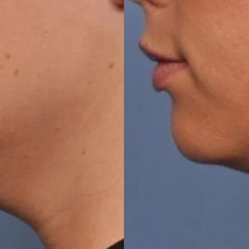 Смас ліфтинг руки + шия + декольте
                    Косметологический центр Safe Cosmo Kyiv Киев