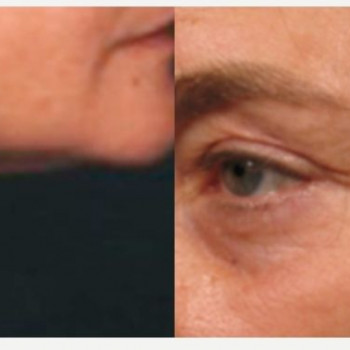 Смас ліфтинг руки + шия + декольте
                    Косметологический центр Safe Cosmo Kyiv Киев