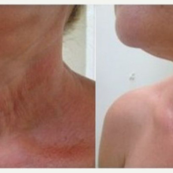 Смас ліфтинг руки + шия + декольте
                    Косметологический центр Safe Cosmo Kyiv Киев