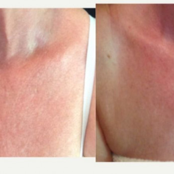 Смас ліфтинг руки + шия + декольте
                    Косметологический центр Safe Cosmo Kyiv Киев