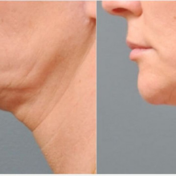 Смас ліфтинг руки + шия + декольте
                    Косметологический центр Safe Cosmo Kyiv Киев