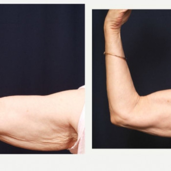 Смас ліфтинг руки + шия + декольте
                    Косметологический центр Safe Cosmo Kyiv Киев