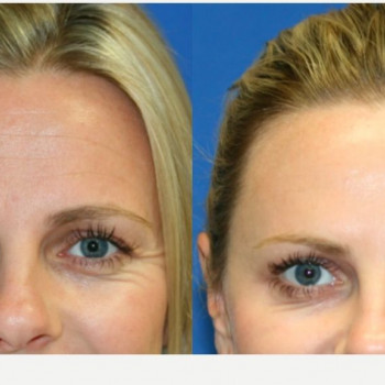 Ботулінотерапія чола
                    Косметологический центр Safe Cosmo Kyiv Киев