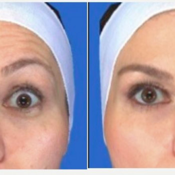 Ботулінотерапія чола
                    Косметологический центр Safe Cosmo Kyiv Киев