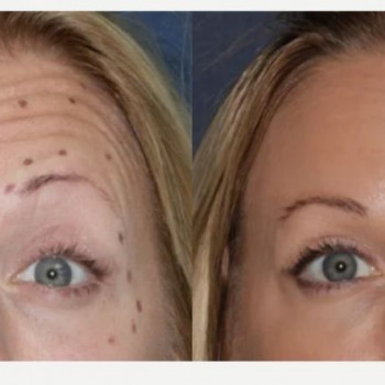 Ботулінотерапія чола
                    Косметологический центр Safe Cosmo Kyiv Киев