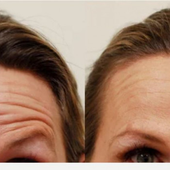 Ботулінотерапія чола
                    Косметологический центр Safe Cosmo Kyiv Киев