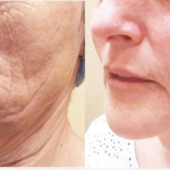 Смас ліфтинг шия + деколте
                    Косметологический центр Safe Cosmo Kyiv Киев