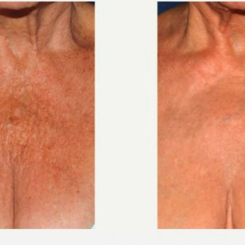 Смас ліфтинг шия + деколте
                    Косметологический центр Safe Cosmo Kyiv Киев