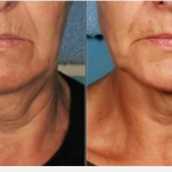 Смас ліфтинг шия + деколте
                    Косметологический центр Safe Cosmo Kyiv Киев