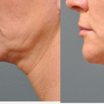 Смас ліфтинг шия + деколте
                    Косметологический центр Safe Cosmo Kyiv Киев