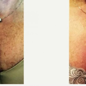 Смас ліфтинг шия + деколте
                    Косметологический центр Safe Cosmo Kyiv Киев