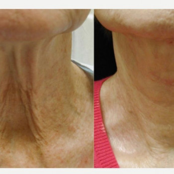 Смас ліфтинг шия + деколте
                    Косметологический центр Safe Cosmo Kyiv Киев