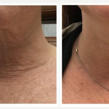 Смас ліфтинг шия + деколте
                    Косметологический центр Safe Cosmo Kyiv Киев