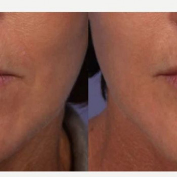 Ботулінотерапія периоральної зони (навколо губ)
                    Косметологический центр Safe Cosmo Kyiv Киев