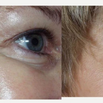 Ботулінотерапія периорбітальна зона
                    Косметологічний центр Safe Cosmo Kyiv Київ