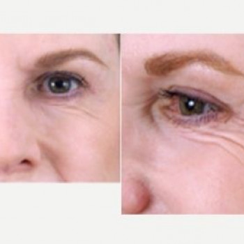 Ботулінотерапія периорбітальна зона
                    Косметологічний центр Safe Cosmo Kyiv Київ