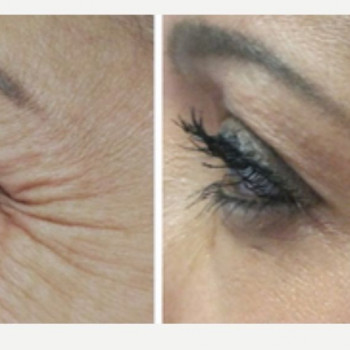 Ботулінотерапія периорбітальна зона
                    Косметологічний центр Safe Cosmo Kyiv Київ