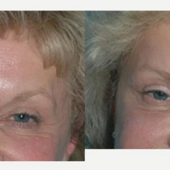 Ботулінотерапія периорбітальна зона
                    Косметологічний центр Safe Cosmo Kyiv Київ