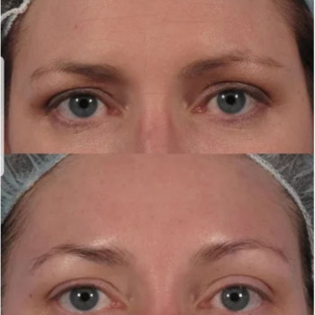 Ботулінотерапія периорбітальна зона
                    Косметологічний центр Safe Cosmo Kyiv Київ