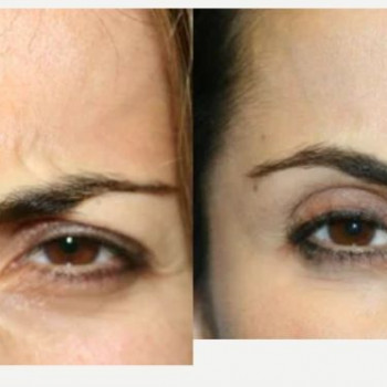 Ботулінотерапія периорбітальна зона
                    Косметологічний центр Safe Cosmo Kyiv Київ