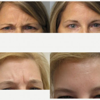 Ботулінотерапія межбрів'я
                    Косметологический центр Safe Cosmo Kyiv Киев