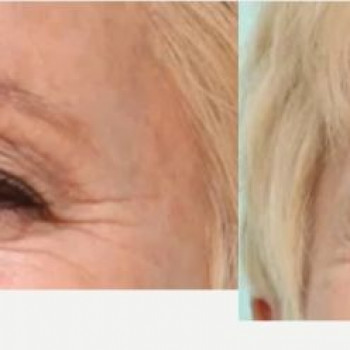 Ботулінотерапія межбрів'я
                    Косметологический центр Safe Cosmo Kyiv Киев