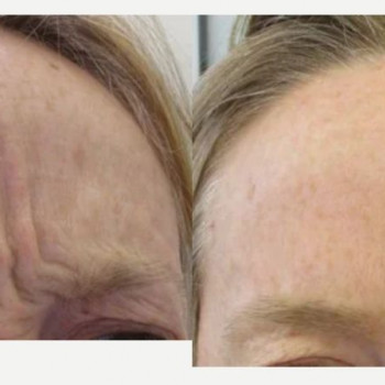 Ботулінотерапія межбрів'я
                    Косметологический центр Safe Cosmo Kyiv Киев