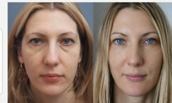Ботулінотерапія Full face Косметологический центр Safe Cosmo Kyiv Киев