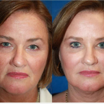 Ботулінотерапія Full face
                    Косметологический центр Safe Cosmo Kyiv Киев