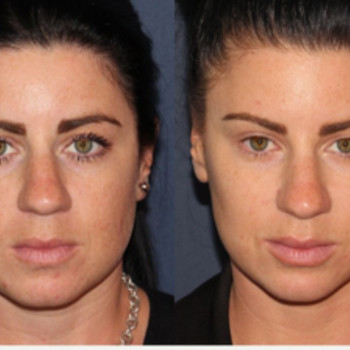 Ботулінотерапія Full face
                    Косметологический центр Safe Cosmo Kyiv Киев