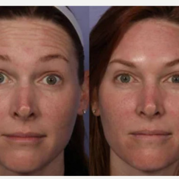 Ботулінотерапія Full face
                    Косметологический центр Safe Cosmo Kyiv Киев