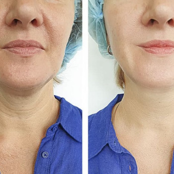 Ліфтинг Ніфертіті
                    Косметологічний центр Safe Cosmo Kyiv Київ