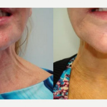 Ліфтинг Ніфертіті
                    Косметологічний центр Safe Cosmo Kyiv Київ