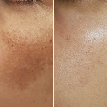 До и после гликолевого пилинга: уменьшение пигментации 