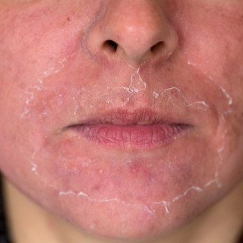 Шкіра після гліколевого пілінга  