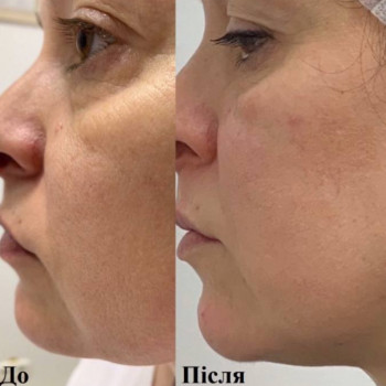 Результат після RF ліфтингу