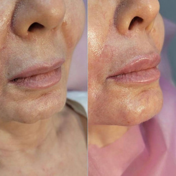 Проведено три процедури:
Зволоження губ
Корекція підборіддя
Заповнення зморшок