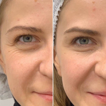 Колагенотерапія зон навколо очей

 