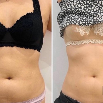 Результат після курсу ліполітиків

 