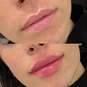 Аугментація губ

 