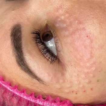 Біоревіталізація зони навколо очей