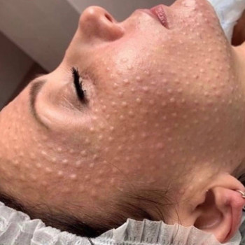 Біоревіталізація обличчя