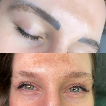 Було 2 видалення ремувером і 2 лазером