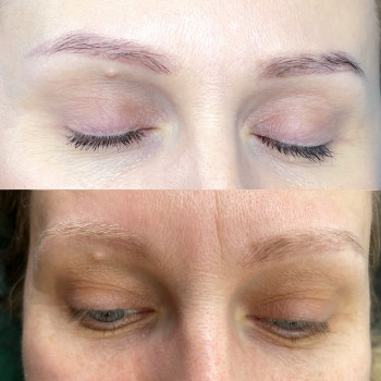 Було два видалення ремувером і один лазером