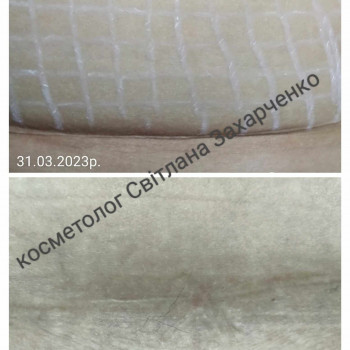 прoцедура , робота з  по тілу (видалення післяопераційного рубця на животі). Результат через рік - п...