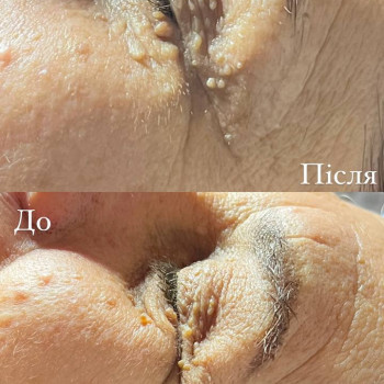  #косметолог #косметологльвів #косметологцентр #доглядовіпроцедури #пілінги #чискаобличчя #плазмотерапія #ботулінотерапія #інєкціїкраси #мезотерапія #біоревіталізація