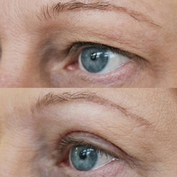 Блефаропластика без хірурга
                    Врач-косметолог Майя Киев